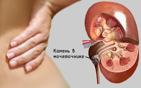 La naturaleza del dolor en la urolitiasis.