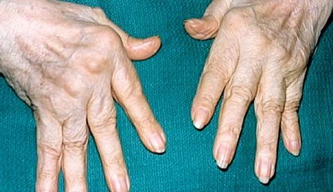 Dolor en las articulaciones de los dedos