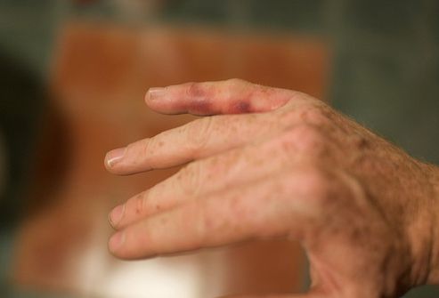 Dolor en las articulaciones de las manos