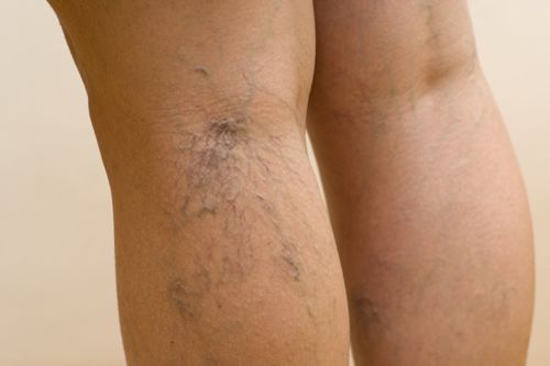 Cómo afrontar la trombosis venosa profunda