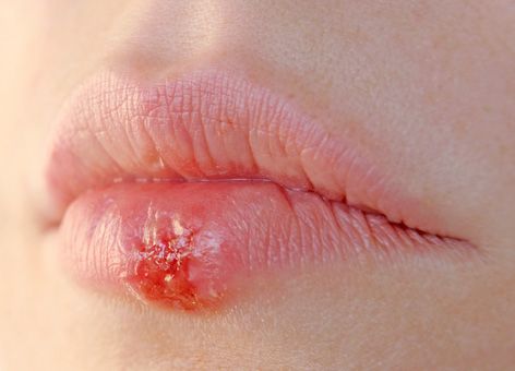 Por qué el herpes "aparece"