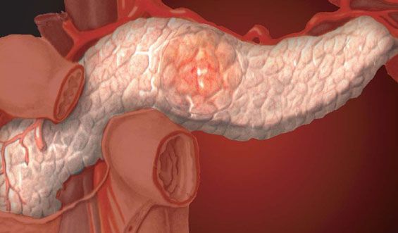 Pancreatitis crónica