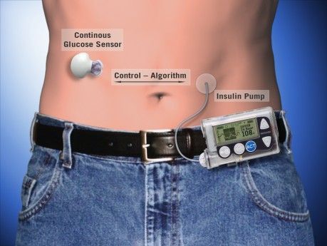 páncreas artificial para la diabetes