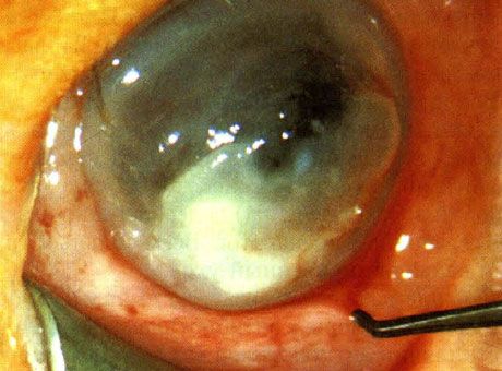 Queratitis causada por Pseudomonas en un recién nacido.  Los factores predisponentes no son identificados