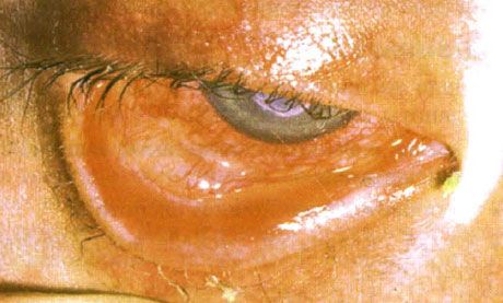 Síndrome de Stevens-Johnson. Conjuntivitis descamativa bilateral con áreas de necrosis. Queratitis grave que causó cicatrización corneal. La situación se complicó con el síndrome del ojo seco.