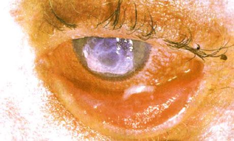 Síndrome de Stevens-Johnson. Conjuntivitis descamativa bilateral con áreas de necrosis. Queratitis grave que causó cicatrización corneal. La situación se complicó con el síndrome del ojo seco.