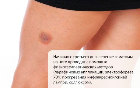 Tratamiento del hematoma en la pierna