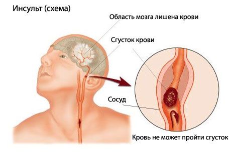 Una prueba sencilla predice un accidente cerebrovascular mortal
