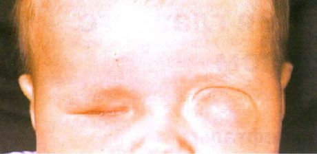 Microftalmo con formación concomitante de quistes (ojo izquierdo).  Anophthalmus (ojo derecho).