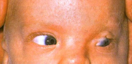 Síndrome de Fraser.  Cryptophthalmos incompleto del ojo izquierdo.