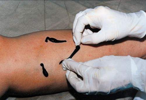 Sanguijuelas contra las varices