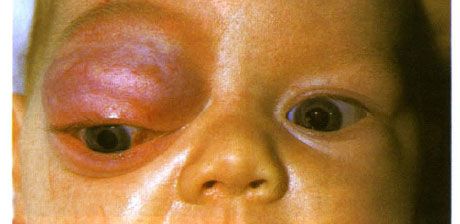 Hemangioma capilar de la órbita anterior y el párpado superior. La neoplasia tiende a progresar.