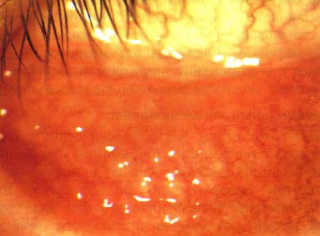 Conjuntivitis folicular aguda en un niño con múltiples lesiones de molusco contagioso