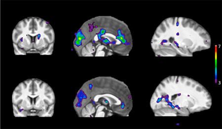 Las exploraciones muestran áreas de actividad cerebral en respuesta a estímulos en personas que metabolizan rápidamente la nicotina (fila superior) y personas que metabolizan lentamente la nicotina (fila inferior).