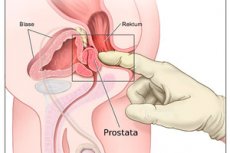 aparat masaj prostata