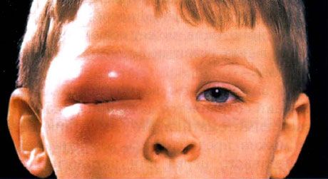 Celulitis extraorbitaria en niños