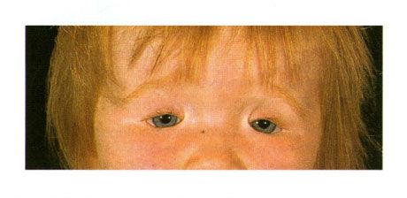 Coloboma de dos lados de los párpados en un niño con síndrome de Golden.  Cierre de la hendidura del ojo a la izquierda
